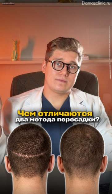 Виды и методы пересадки волос: FUE и FUT